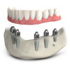 TeethXpress immediate load solutions